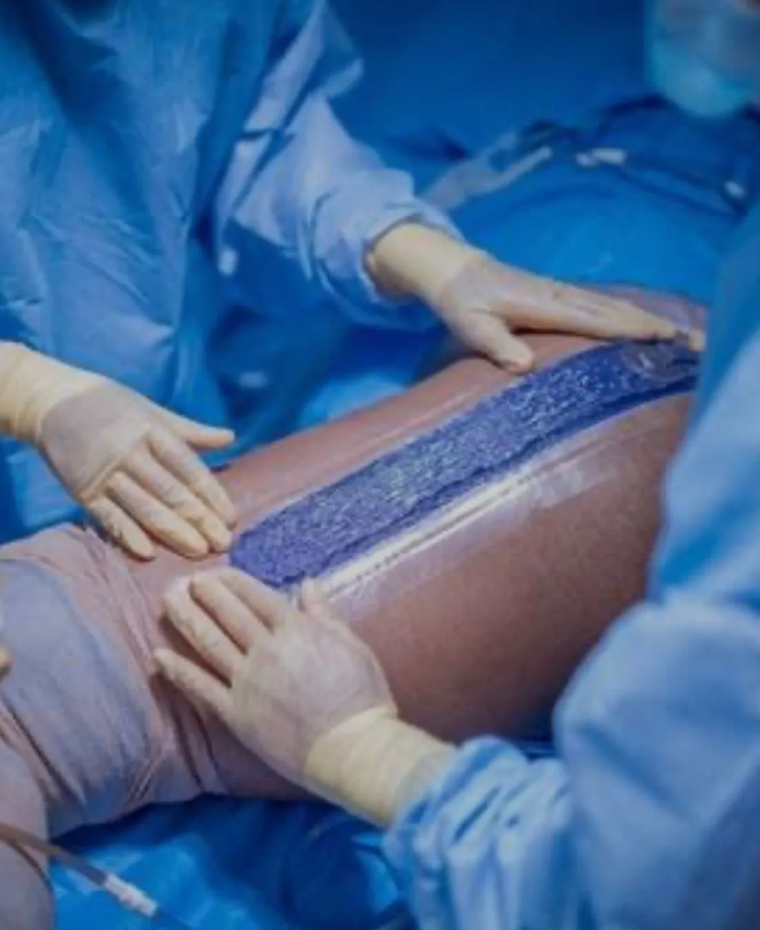 Curativo a vácuo: solução para cuidado e manejo avançado de feridas