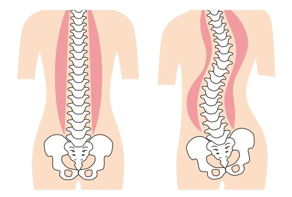 6 milhões de brasileiros sofrem com a escoliose. Imagem: Divulgação